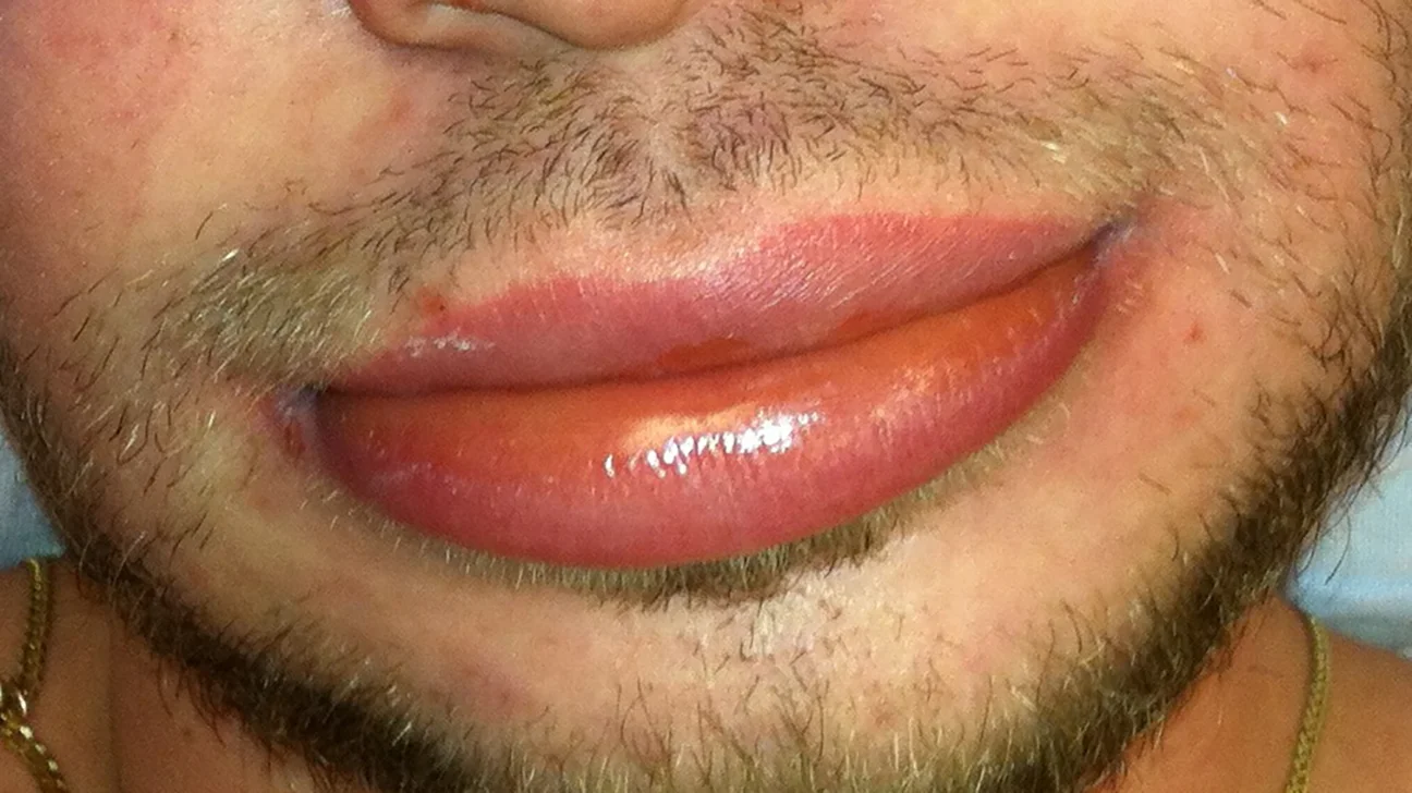 Why Are My Lips Big In The Morning? 
