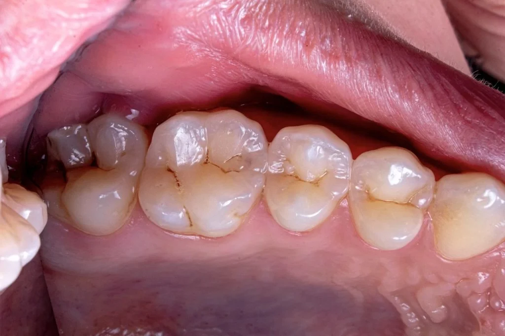 What Are The  Potential Reasons for Tooth Infection Recurrence