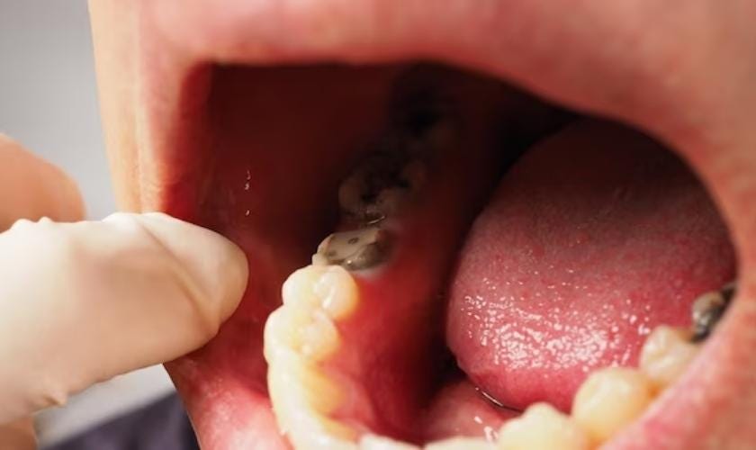 how long before tooth infection comes back after antibiotics